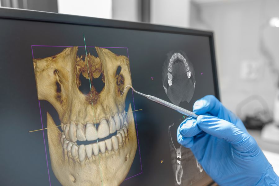tomografia żuchwy, tomografii zęba, głowica tomografu, ubytki kostne